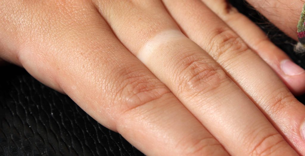Look down at their hands does their ring finger have a dent